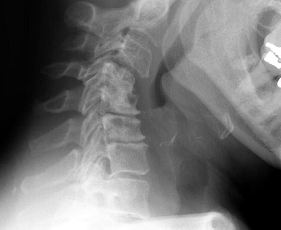 Rheumatoid Arthritis Subaxial Instability